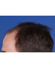 Before Hair Transplant&nbsp;Front